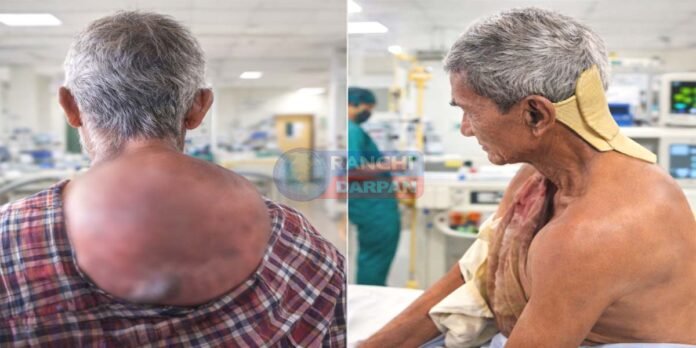 17 साल की पीड़ा का अंत: रांची सदर अस्पताल में 5 किलो का सर्वाइकल ट्यूमर निकाला